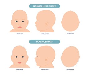 craniosynostosis helmet pillow flat head autism brain skull bone deformity baby infant child newborn defect birth anterior Metopic Born genes genetic position sleep shape deformation tummy time 
