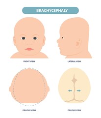 craniosynostosis helmet pillow flat head autism brain skull bone deformity baby infant child newborn defect birth anterior Metopic Born genes genetic position sleep shape deformation tummy time  - obrazy, fototapety, plakaty