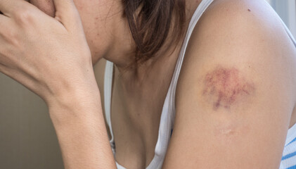 A woman in a white-blue T-shirt with a bruise on her arm after the beatings touches the injury with her hand while sitting at the window close-up