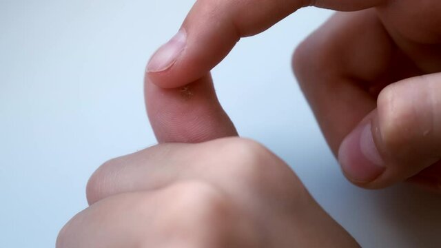 Big wart, verruca on human thumb finger before laser removing on grey backgroung, closeup view. Human papillomavirus, weakened immunity, treatment of warts. Doctor is touching boy's finger.