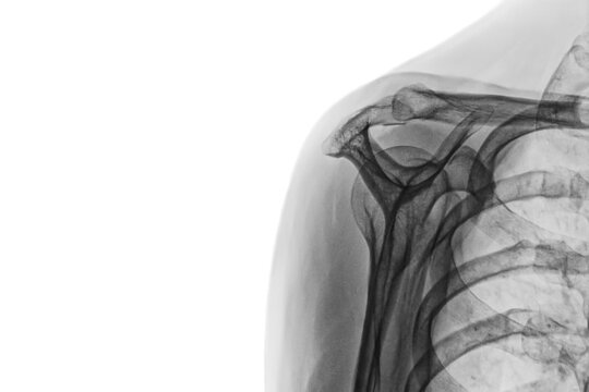 x ray image of a body. Xray image of female shoulder isolated on white background. diagnosis Subacromial Syndrome 