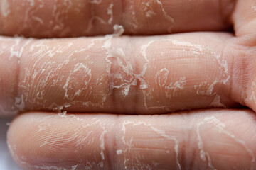 Peeling skin on hand and fingers. Desquamation