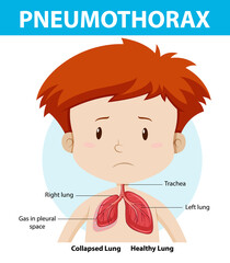 Pneumothorax diagram of human anatomy