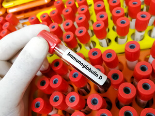 Fototapeta premium Technician hold blood sample for IgD (Immunoglobulin D) test.
