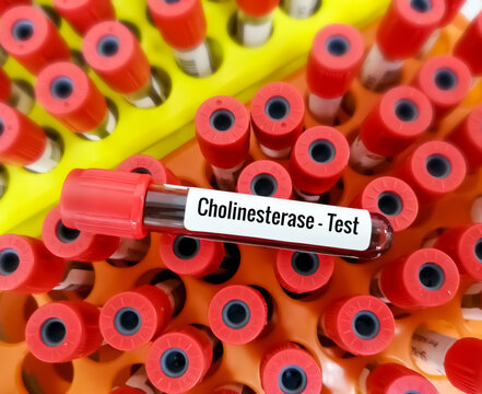 Blood sample isolated for Cholinesterase test. Close view