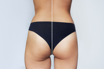 A close-up of female buttocks before and after liposuction or anti-cellulite treatment. Getting rid of excess weight, diet, proper nutrition, training, sports, massage, scrub. Health care, wellness - obrazy, fototapety, plakaty