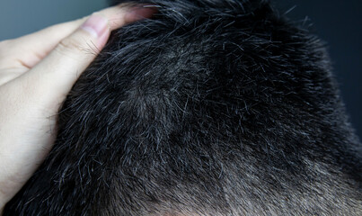 premature gray hair. Young Asian man showing gray hair on his head 