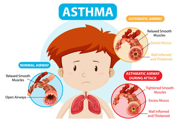Asthma diagram with normal airway and asthmatic airway - obrazy, fototapety, plakaty