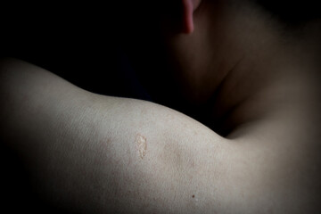 The scar on arm from vaccination for prophylaxis, the reaction of Bacillus Calmette Guerin, or BCG vaccination on left shoulder. concept of health care