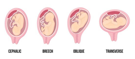 Different wrong baby positions in uterus during pregnancy. Cephalic, Breech, transverse, Oblique lies.