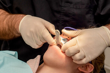 Otrhodontist or dentist making a teeth impression mold. Orthodontic treatment. Dental impression...