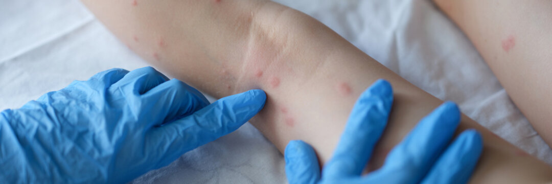 Doctor dermatologist in rubber gloves examining rash on skin of child feet closeup