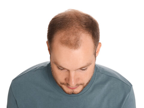 Man with hair loss problem isolated on white, above view. Trichology treatment