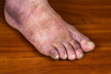 Human foot fracture. Huge purple bruise on a man's leg