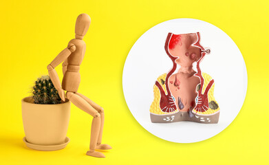 Wooden human figure on cactus and anatomical model of rectum with hemorrhoids against yellow background