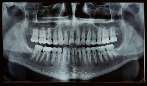 Detalle de una radiografía dental panoramica, Placa dse rayos X vista en un monitor
