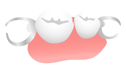 部分入れ歯 © asamizu