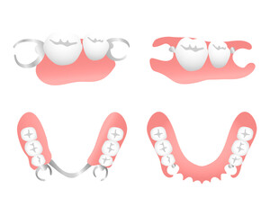 ノンクラスプデンチャーと保険の入れ歯