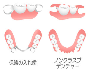 ノンクラスプデンチャーと保険の入れ歯（テキスト入り）