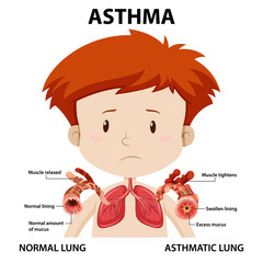Asthma diagram with normal lung and asthmatic lung