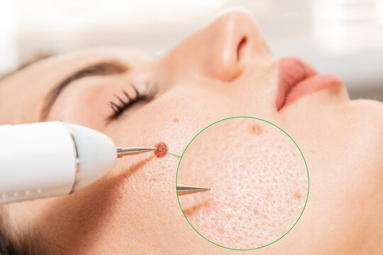 Electrocoagulation and laser cosmelotogy. Dermatologist surgeon using a professional electrocautery for removing mole. Comparison of results before and after operation