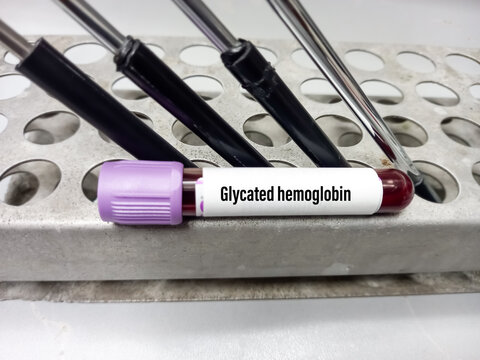 Blood Sample For Glycated Hemoglobin Or HbA1c Test, Diabetic Treatment Monitoring Test