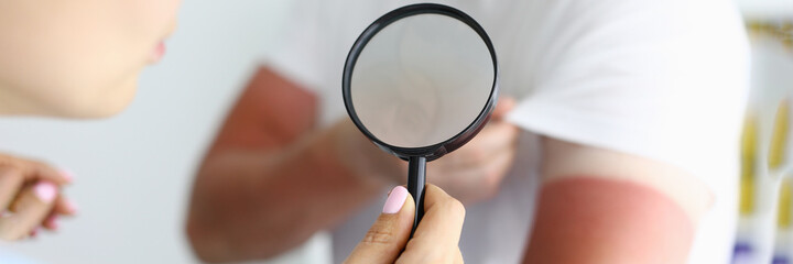 Doctor examining sunburns on patient arm using magnifying glass closeup