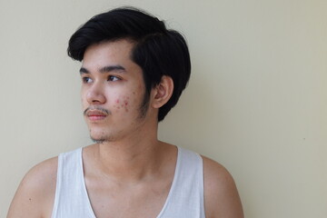Young man 15 year old. With full face of acne problem or pimple on face Asian young boy