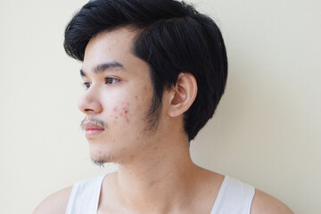 Young man 15 year old. With full face of acne problem or pimple on face Asian young boy