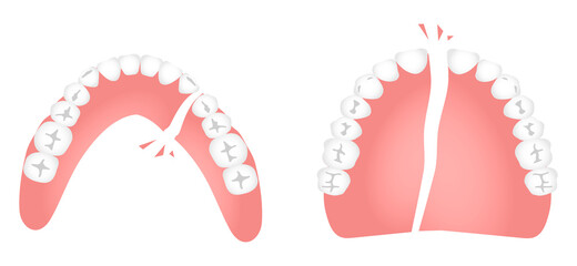 割れた入れ歯（上下） © asamizu