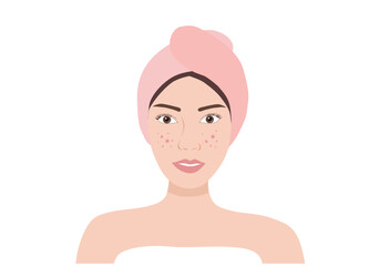 Acne face skin woman vector illustration