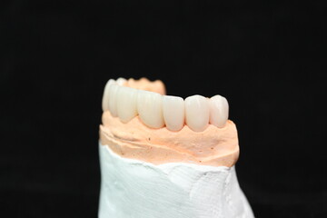 Dental crowns in the plaster model for treatment and new smile