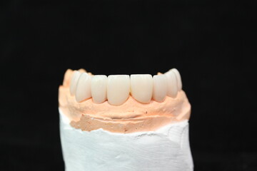 Dental crowns in the plaster model for treatment and new smile