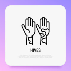 Hives on hand thin line icon. Allergy symptom. Modern vector illustration of allergic reaction.