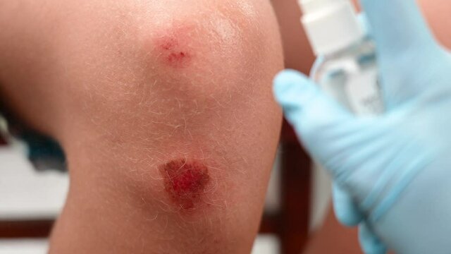 Close-up view 4k video footage of injured young kid's knee after he fell down on pavement. Nurse cleaning leg injury, inspecting boy's wounded scraped red bleeding painful skin of leg
