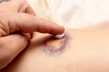 Applying ointment on the hematoma. Hematoma treatment