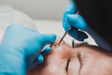 Mechanical cleansing of the face with a spoon uno, removing grease and blackheads.