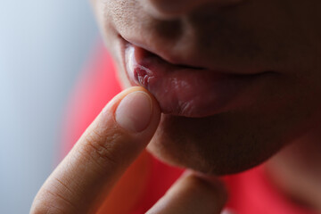 Man holding broken lip with hematoma with his hand closeup