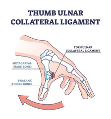 Thumb ulnar collateral ligament as finger injury and problem outline diagram. Labeled educational hand xray with bones and cartilage after medical condition and pain explanation vector illustration.