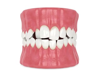 3d render of jaw with abnormal toothing isolated over white background