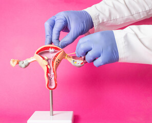 Doctor gynecologist ligates the fallopian tubes on the example of the layout of the female reproductive system, pink background. Contraception concept against unwanted pregnancy, surgery in gynecology - obrazy, fototapety, plakaty