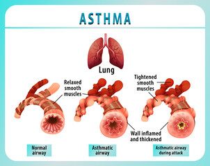 Bronchial Asthma diagram with normal airway and asthmatic airway