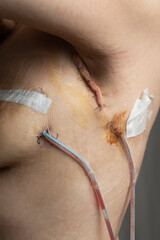 Woman shows scars from an axillary lymph node dissection following bilateral mastectomy due to...
