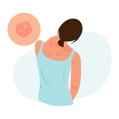 The woman is scratching her back.  Pustular psoriasis.Allergic itching, skin inflammation, redness and irritation. Atopic dermatitis, eczema, psoriasis, dry skin. Skin problems