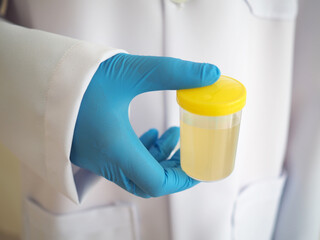A doctor holding plastic jar with urine. closeup photo, blurred.