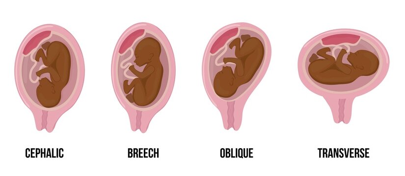 African black skin baby. Different wrong baby positions in uterus during pregnancy.