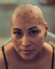 The new haircut offered by cancer.
Chemotherapy makes her hair fall out. - obrazy, fototapety, plakaty
