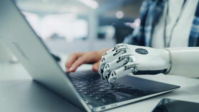 Close-up on Hands: Programmer With Disability Using Prosthetic Arm to Work on Laptop Computer. Specialist Swift and Natural Use of Myoelectric Bionic Hand To Type Code for Software