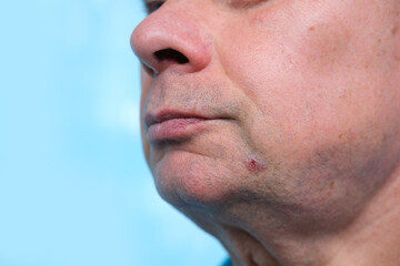 man with a herpes wound on the chin, viral skin rashes with weakened immunity, treatment of skin diseases
