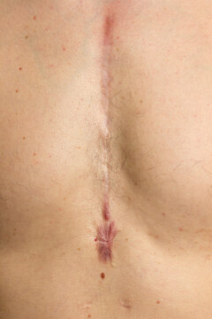 Male person's chest with heart surgery scar